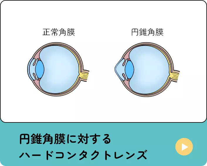 円錐角膜に対するハードコンタクトレンズ