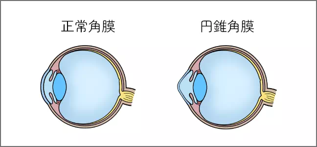 正常角膜 円錐角膜